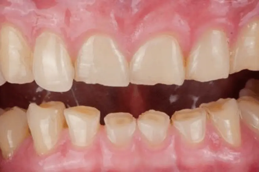 Bruxism Treatment In Ahmedabad Bruxism Treatment In Ahmedabad
