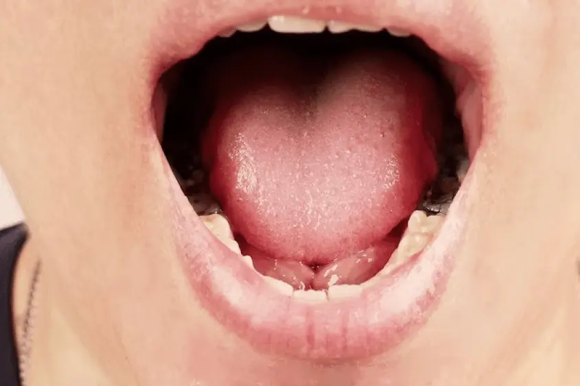 Burning Mouth Syndrome Treatment In Ahmedabad Burning Mouth Syndrome Treatment In Ahmedabad