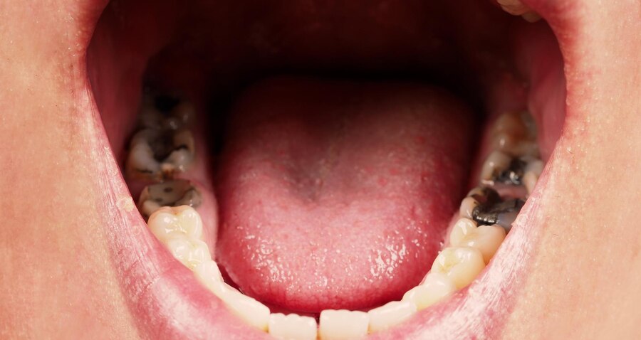 Oral Submucous Fibrosis Treatment In Ahmedabad Oral Submucous Fibrosis Treatment In Ahmedabad